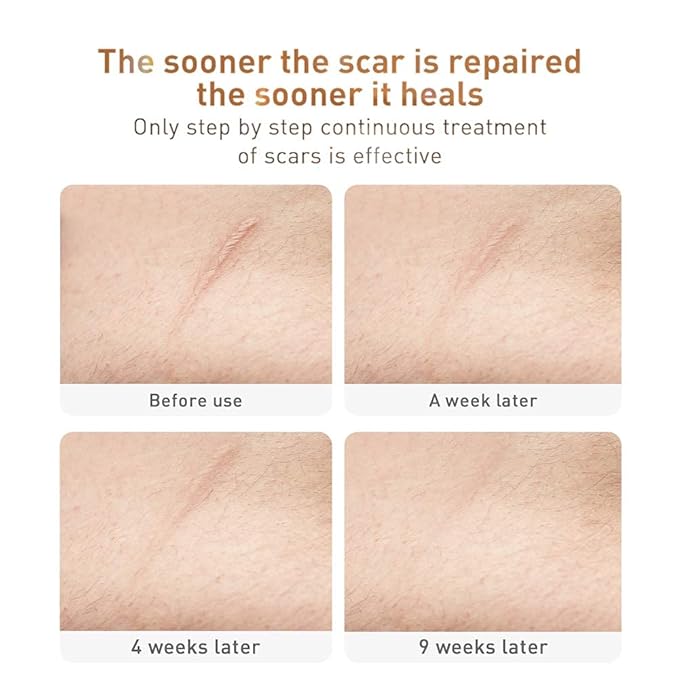 Acne Scar Removal Cream Stretch Marks Face Skin Cream Shrink Pores Gel-Fade Scar Marks Acne Skin Care (Packaging Upgrade) VeniCare