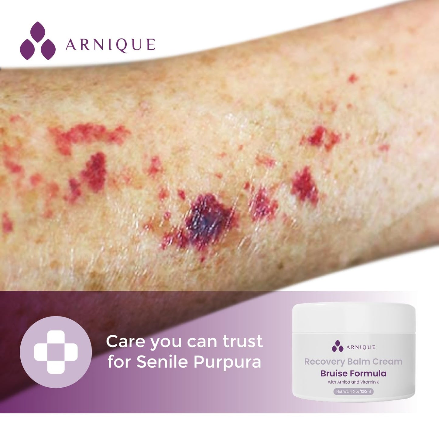 Arnica Bruise Cream with Vitamin K, Extra Strength Fast Healing Thin Skin Formula, Senile Purpura or Redness, Visibly Aide Remove Bruises Elderly and Fragile Skin, Surgery Aftercare