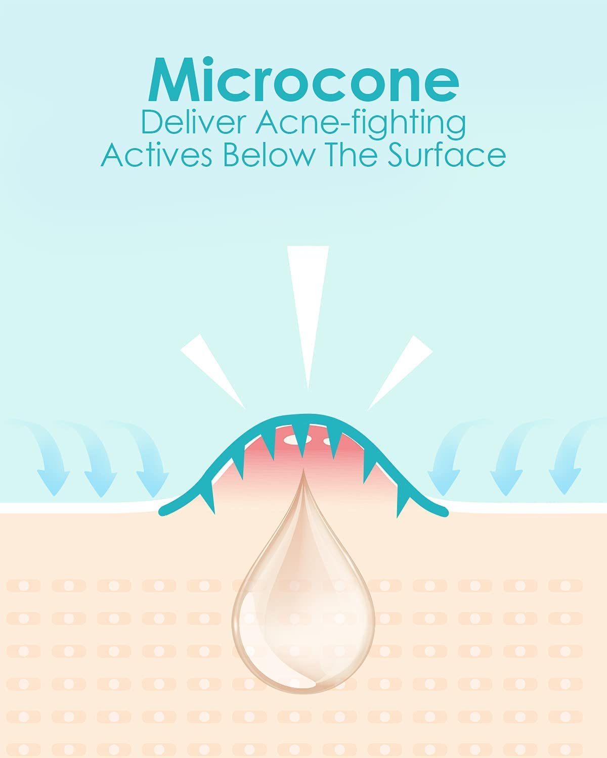 Microdart Acne Patch (36 Patches) - Hyaluronate Acid & Salicylic Acid Hydrocolloid Pimple Patch for Deep, Early and Hidden Blemishes (36 Count (Pack of 1))