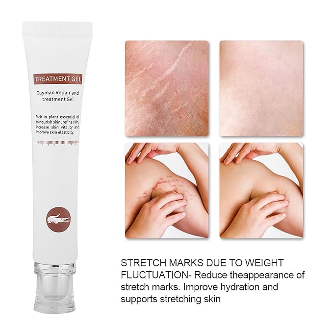 Generic Stretch Marks Removal Cream, Reduce Old Marks, Restore Elasticity, Firm & Lift Skin, Safe & Ingredients, 30g, Compact Size