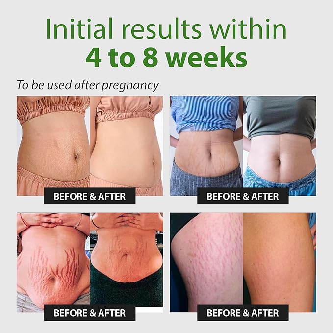 Abera Ovela Stretch Mark Cream, Stretch Marks Treatment For Pregnancy and Weight Fluctuations, Effective Treatment for Stretchmarks in All Skin Types (A. 1 Box + Ice Roller)